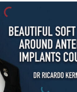 Beautiful Soft Tissue Around Anterior Implants