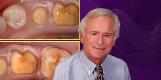 OHI- S Biologic Shaping: a conservative alternative to crown lengthening