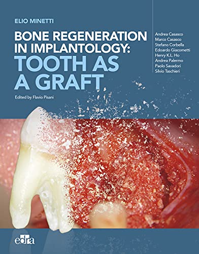Bone regeneration in implantology: tooth as a graft PDF