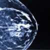 Breast Imaging and Digital Mammography