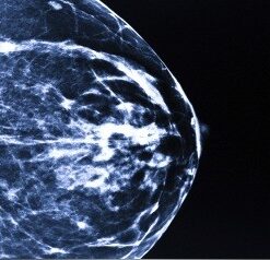 Breast Imaging and Digital Mammography