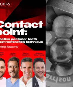 Contact point: effective posterior teeth direct restoration technique