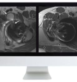 Controversies in Hip and Pelvis Imaging