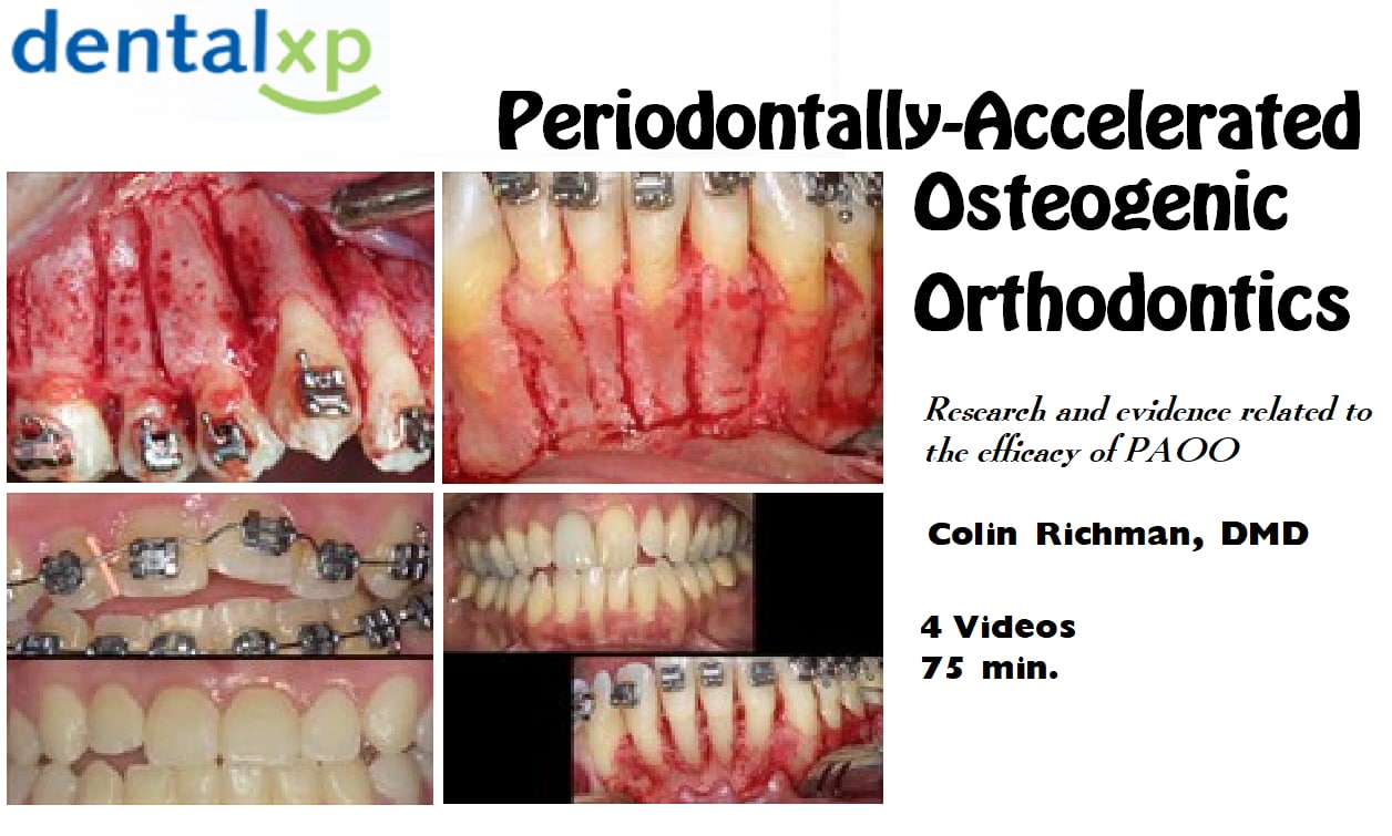 DentalXP Periodontally-Accelerated Osteogenic Orthodontics / Colin Richman