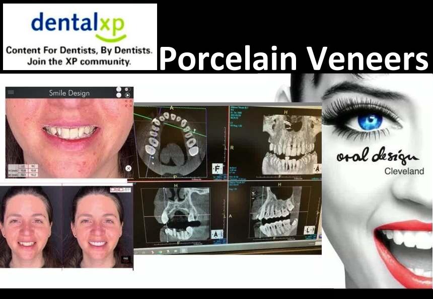 DentalXP Porcelain Veneers DentalXP Porcelain Veneers