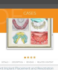 gIDE ondemand lectures - Edentulous Patient Implant Placement and Restoration
