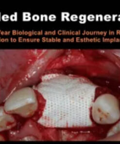 Guided Bone Regeneration: A 30 year Biological and Clinical Journey in Ridge Augmentation