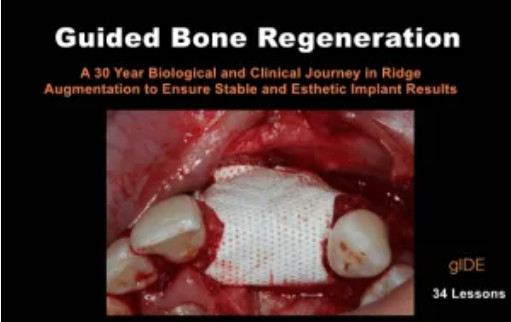 Guided Bone Regeneration: A 30 year Biological and Clinical Journey in Ridge Augmentation Guided Bone Regeneration: A 30 year Biological and Clinical Journey in Ridge Augmentation