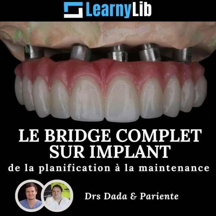 LearnyLib Le Bridge Complet sur Implant - Dada, Pariente de la plantification a la maintenance
