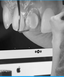 Masking the Dark Tooth with Direct Resin