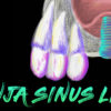 Implant Ninja Introduces Sinus Lifting Master