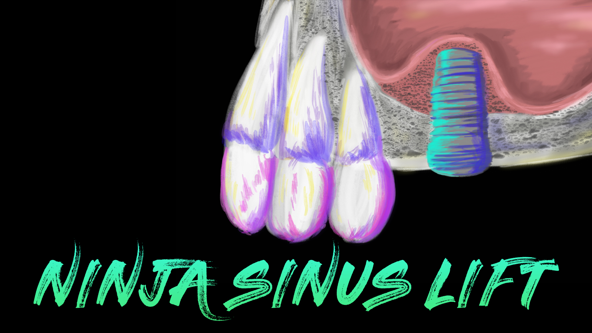 Implant Ninja Introduces Sinus Lifting Master Implant Ninja Introduces Sinus Lifting Master