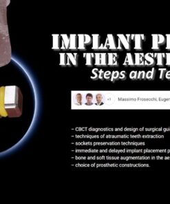 OHI-S Implant Placement in the Aesthetic Zone: Steps and Technique