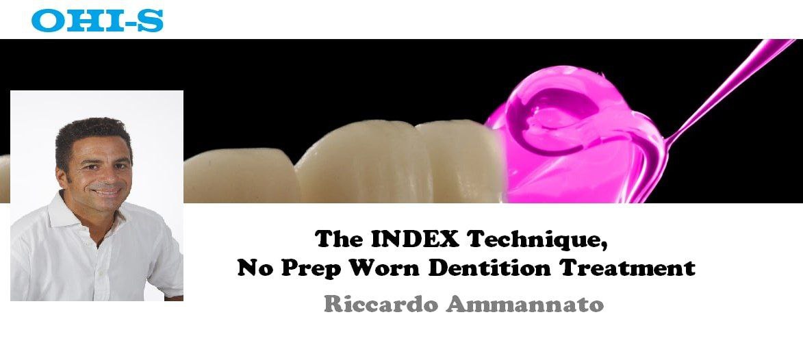 OHI-S - The Index Technique - No Prep Worn Dentition Treatment - Riccardo Ammannato