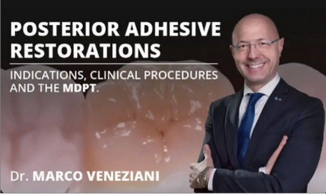 Osteocom Posterior Adhesive Restorations: Indications, Clinical Procedures and mDPT Techniques / Marco Veneziani Osteocom Posterior Adhesive Restorations: Indications, Clinical Procedures and mDPT Techniques / Marco Veneziani