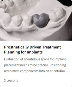 Prosthetically Driven Treatment Planning for Implants