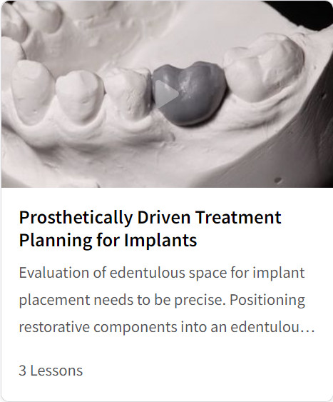 Prosthetically Driven Treatment Planning for Implants