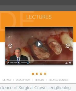 gIDE ondemand lectures - The Art and Science of Surgical Crown Lengthening  