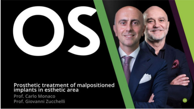 Prosthetic Treatment of Malpositioned Implants in Esthetic Area