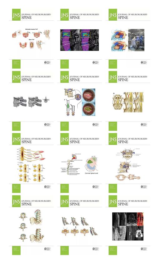 Journal of Neurosurgery: Spine 2022 Full Archives (True PDF)