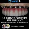 LearnyLib Le Bridge Complet sur Implant – Dada, Pariente de la plantification a la maintenance LearnyLib Le Bridge Complet sur Implant – Dada, Pariente de la plantification a la maintenance
