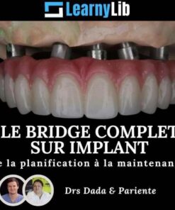 LearnyLib Le Bridge Complet sur Implant – Dada, Pariente de la plantification a la maintenance
